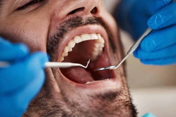 Best Emergency Wisdom Tooth Extraction in Konawa, OK